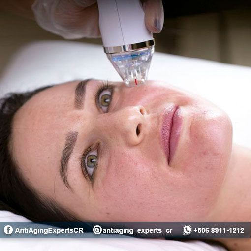 Fractional Radiofrequency With Microneedling